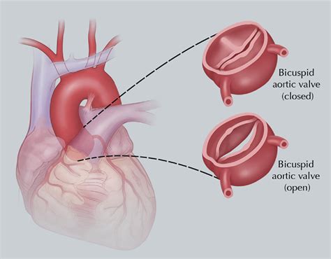 bicuspid aortic valve disease jacc