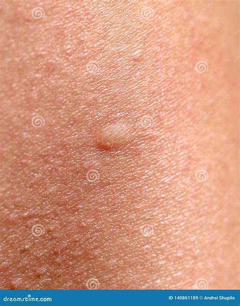 Bee Sting. Bee Sting In Human Skin. Consequences Of Stinging With Bee