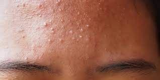 What causes acne on the forehead? Know the cause