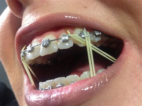 Sara Berry: Adult Braces: Update 4!