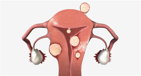 how to shrink fibroids 2