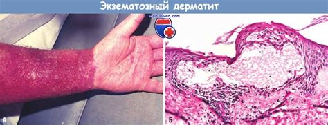 Причины и механизмы развития экземы (экзематозного дерматита)