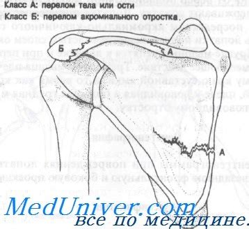 Перелом акромиального отростка лопатки. Диагностика и лечение