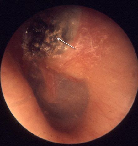 Cholesteatoma - Wikipedia