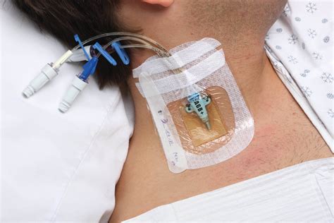 Vascular Access Catheter Materials And Evolution 2