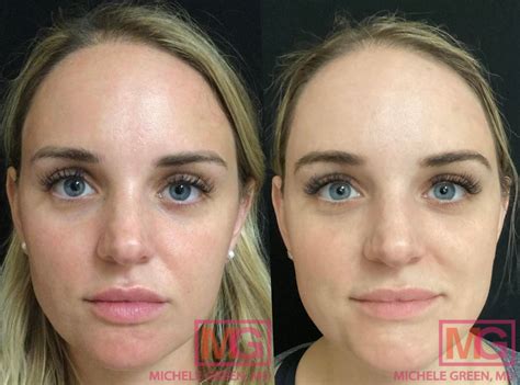 bruising  cheek fillers   prevention