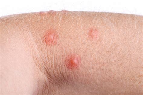 Flea bites vs. bed bug bites, difference in symptoms and treatments