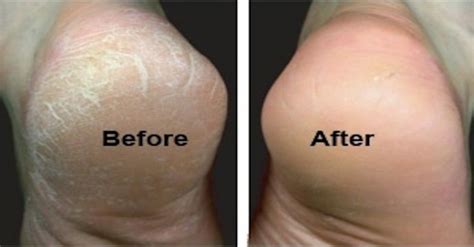 Pedicure therapy for cracked dry feet - Blog @ SpaSalon.us