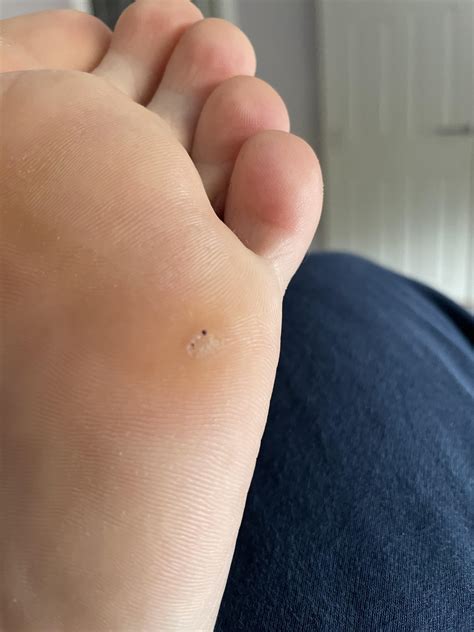 No BS how to fully remove wart forever and very satisfying : r/Warts