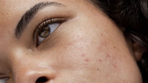 break  la gi xu ly nhu  nao khi da bi break  obagi medical