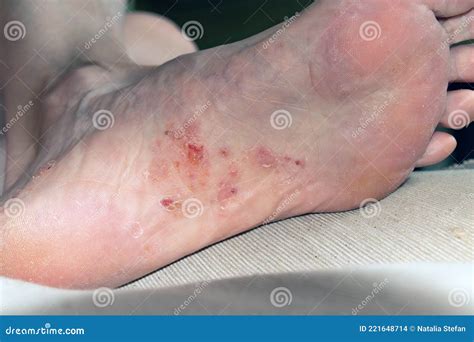Pe Descascando Na Sola - Pé Com Eczema Dermatite Pele Descascando Foto de Stock - Imagem de pele ...