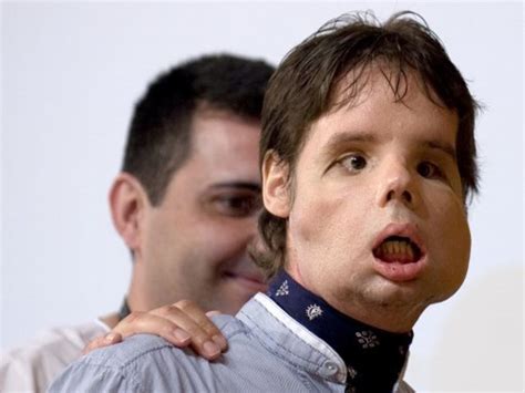 Photos of the world's first full face transplant · The Daily Edge