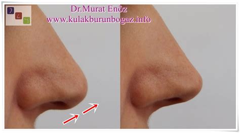 droopy nose tip   treatment