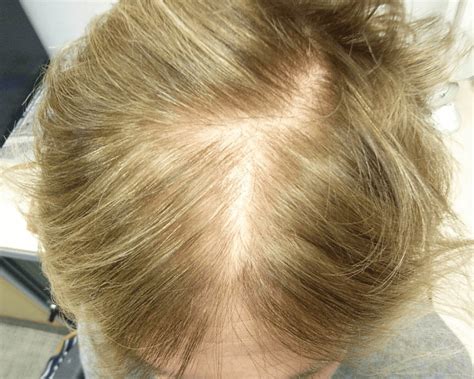 telogen effluvium beforeafter treatment   hair centre