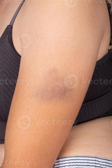 hematoma en la hembra, hematoma en el brazo de la mujer 10140690 Foto