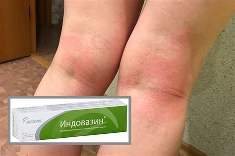 Индовазин: мазь (гель): инструкция по применению, цена, для чего и от ...