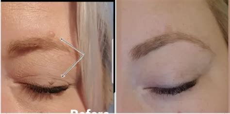 Eyelid Mole Removal | Solent Vascular Care