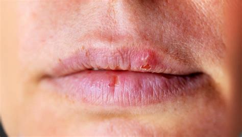 Over 1 in 5 adults worldwide has a genital herpes infection - First Check