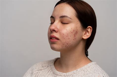 acne     rid  acne ipal clinic