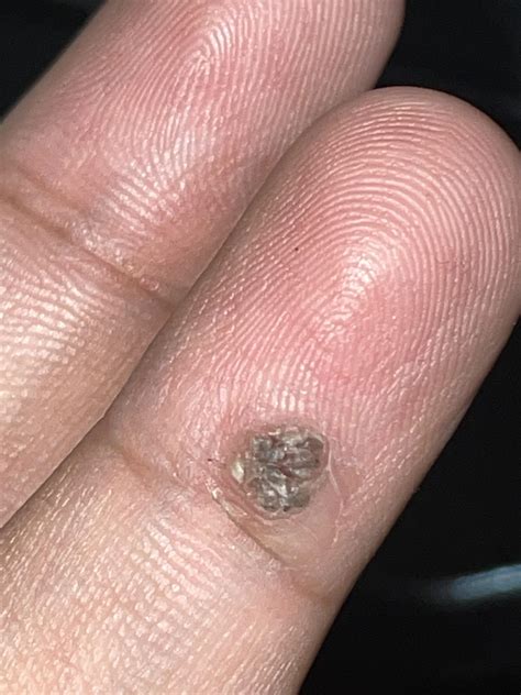 How to remove a wart : r/Warts