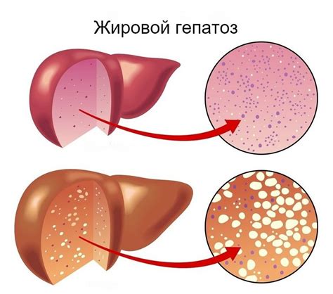 Почему болит печень