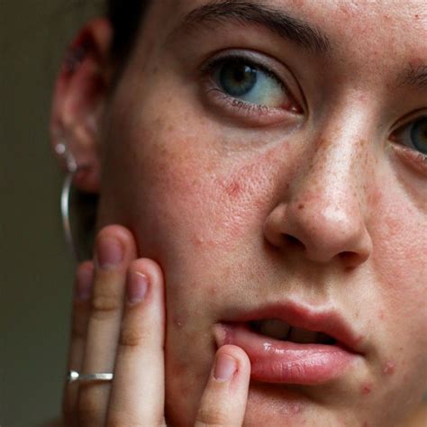 repair  skin     healing  damaged skin barrier