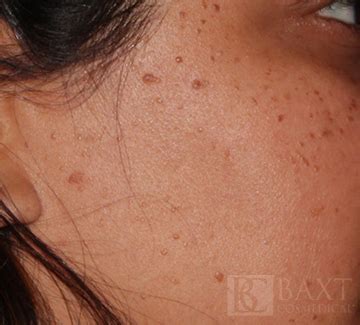 Mole & Lesion Removal Gallery - 6 months post-procedure
