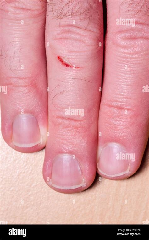 Blessure humaine petite coupure Banque de photographies et d’images à ...