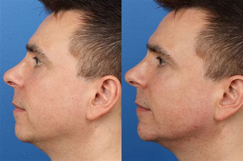 Jaw Contouring New York City | Gotham Plastic Surgery