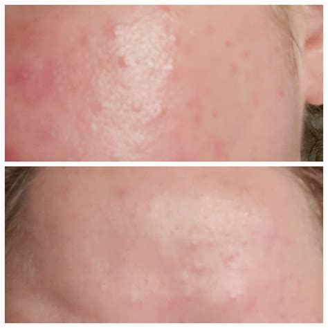 Rosacea? Allergic reaction? Acne? : r/DermatologyQuestions