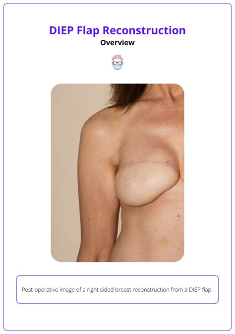 DIEP Flap Reconstruction: Anatomy, Key Surgical Steps, & Complications