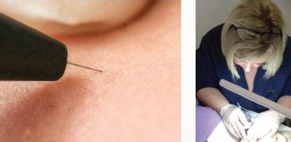 Electrolysis - The Beauty Spot Cosmetic Clinic