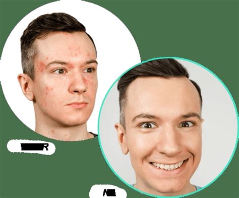 Revamin Acne Cream - Rechtstreeks van de fabrikant in promotie -55%