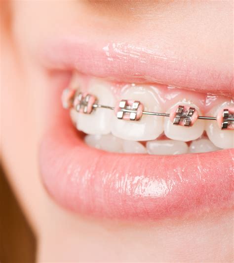 types  braces