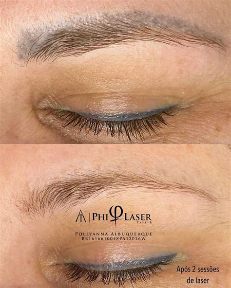Eyebrow Semi Permanent Makeup Removal | Saubhaya Makeup