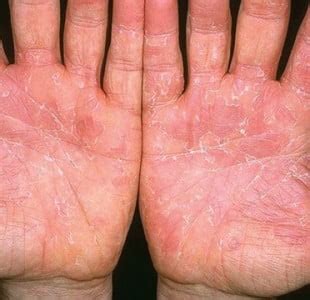 Exfoliative Keratolysis – DermaTalk