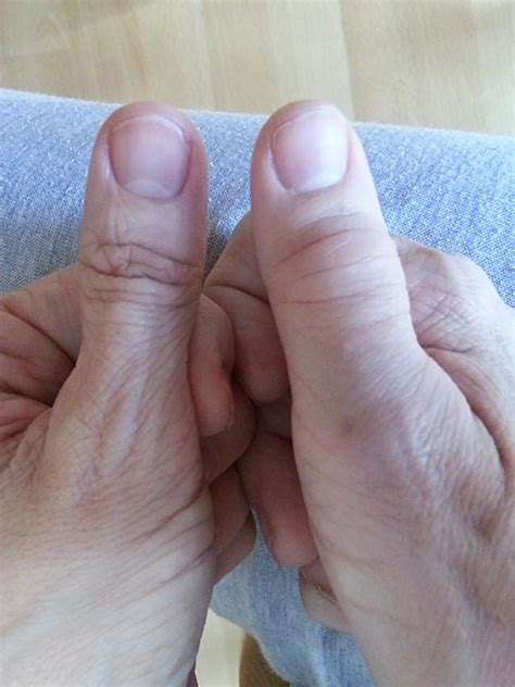 swollen right thumb joints | Rheumatoid Arthritis Warrior