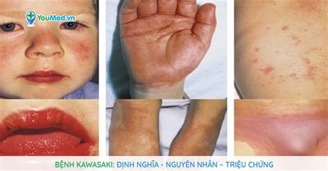 benh kawasaki nguyen nhan trieu chung va cach dieu tri youmed