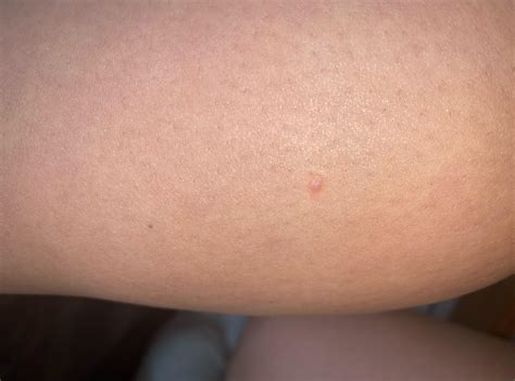 Is this a wart? I(f19) found it on the back of my leg, idk if it’s