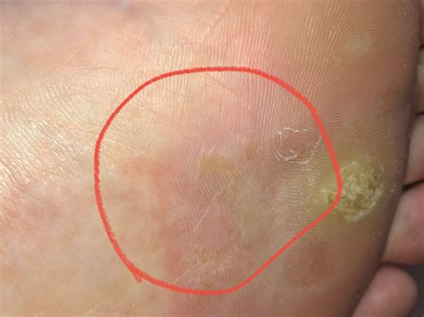 Has my plantar wart spread? : Warts