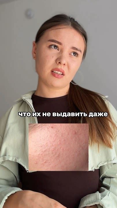 БУГОРКИ НА КОЖЕ! Как избавиться ? Арт ВБ на сыворотку против акне ...