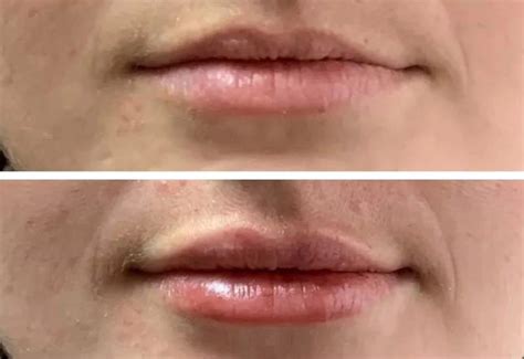 lip fillers    ml diaminyaesthetics