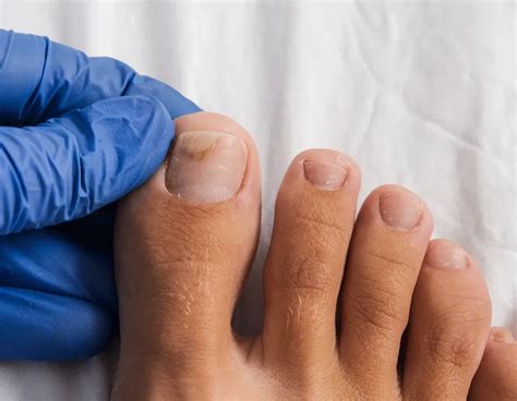 Fungal Nails for Savannah, TN and Corinth, MS | Dr. Robert Darrin Hurst ...