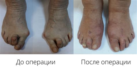 Лечим искривление первого пальца стопы – Медцентр ЕЛАМЕД