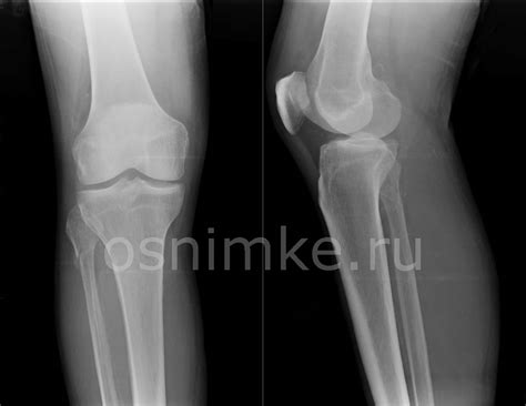 Рентген коленного сустава: что показывает снимок в двух проекциях, как ...