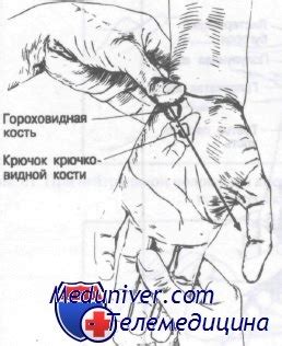 Переломы костей запястья. Классификация, диагностика