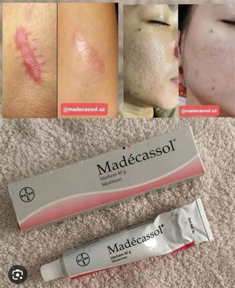 Крем madecassol 1% (оригінал) стриї шрами постакне — цена 420 грн в ...