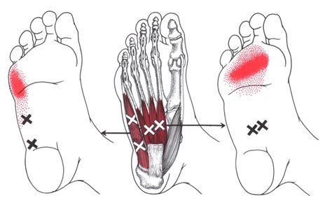Flexor Digitorum Brevis (Foot) | The Trigger Point & Referred Pain Guide