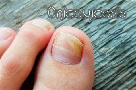 Onicomicosis – Clinica Hispana Airline