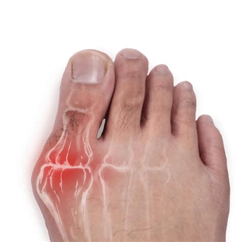 Signs That You May Have a Bunion | Victoria Foot & Ankle
